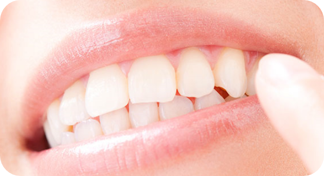 ホワイトニング